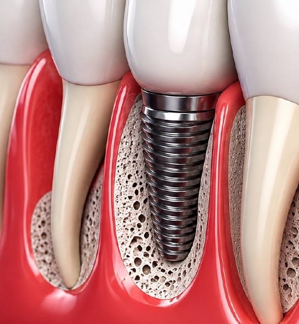 Dental Implants