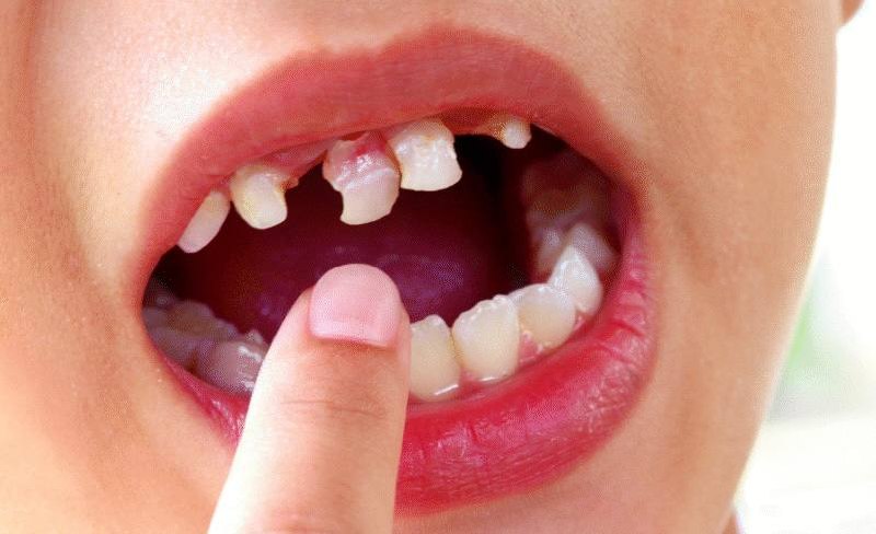 Dental Trauma
