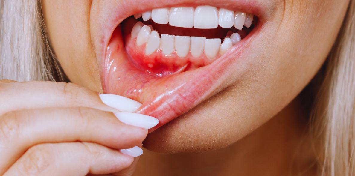 Gum Surgery