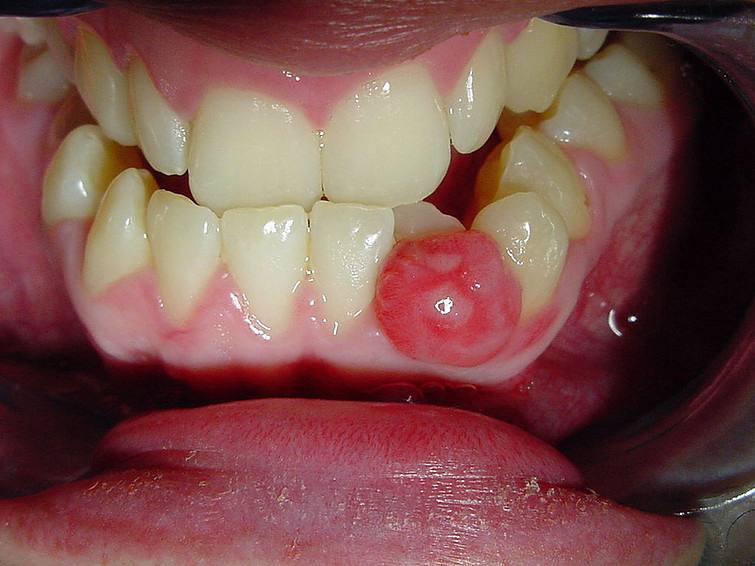 Oral Biopsy