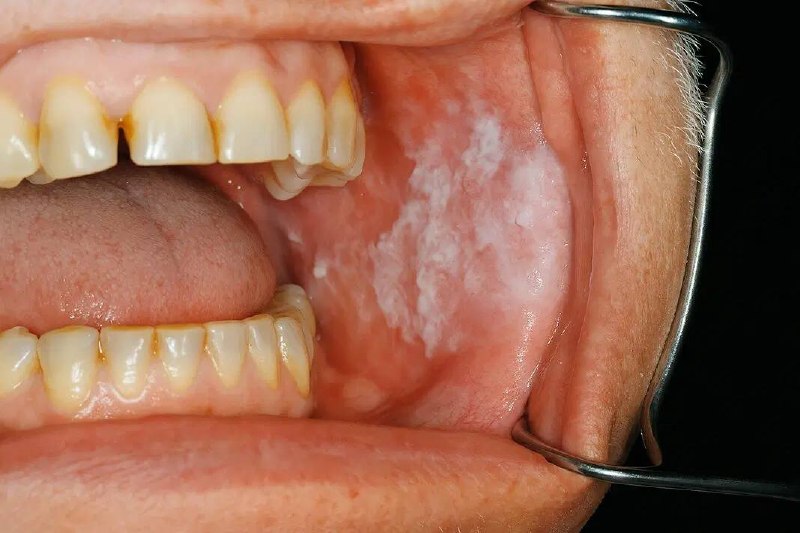 Oral Lesions Management