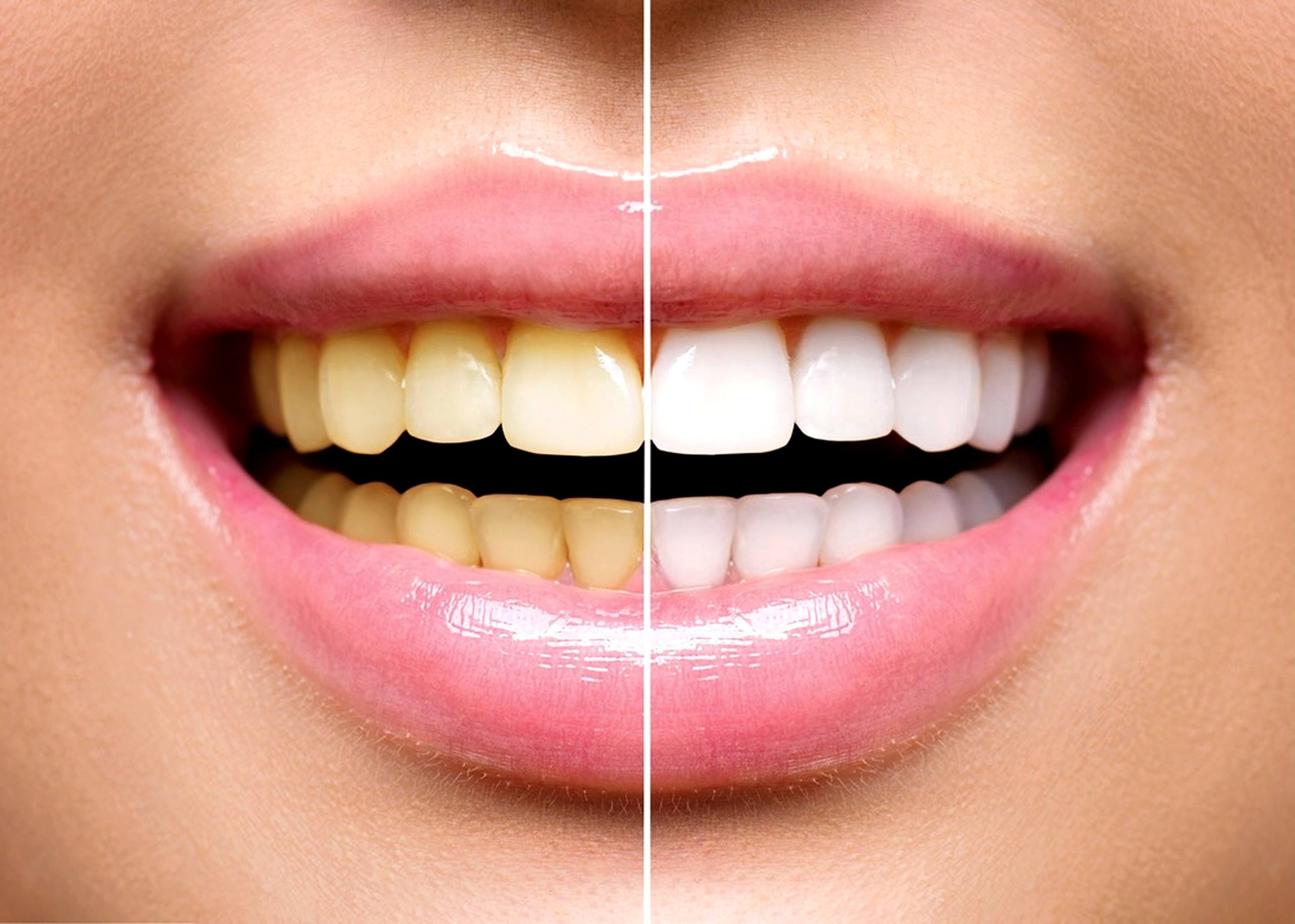 Teeth Whitening
