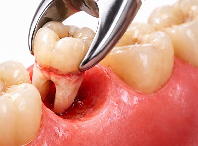 Tooth Extractions