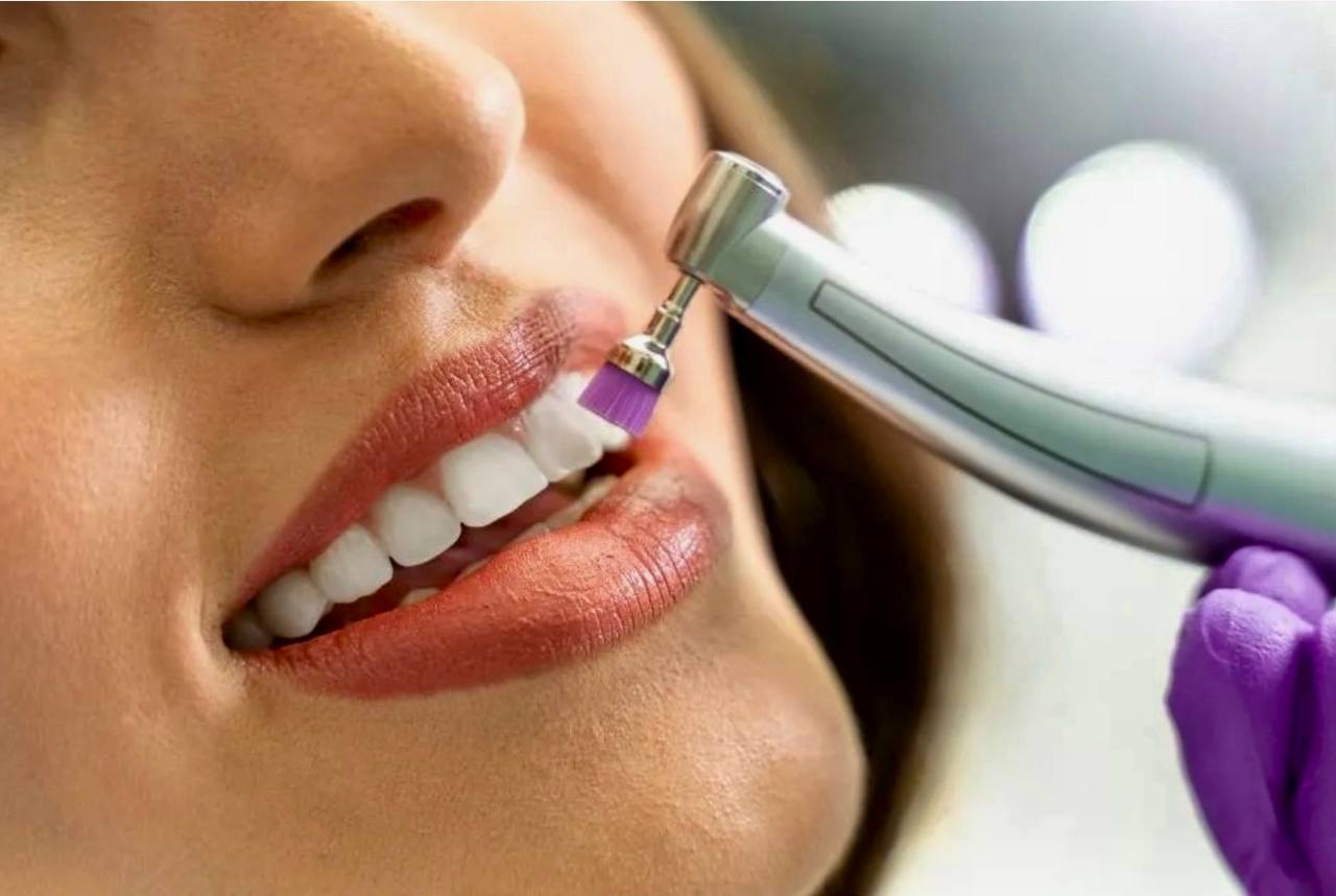 Teeth Polishing