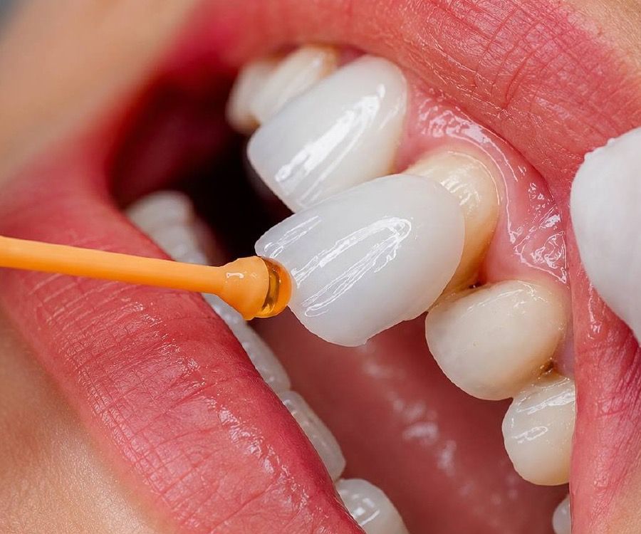 Veneers