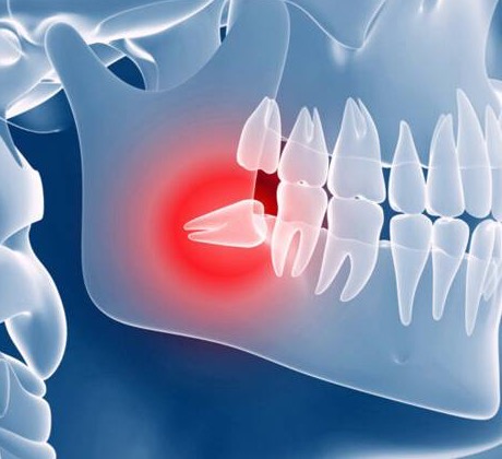 Wisdom Tooth Removal